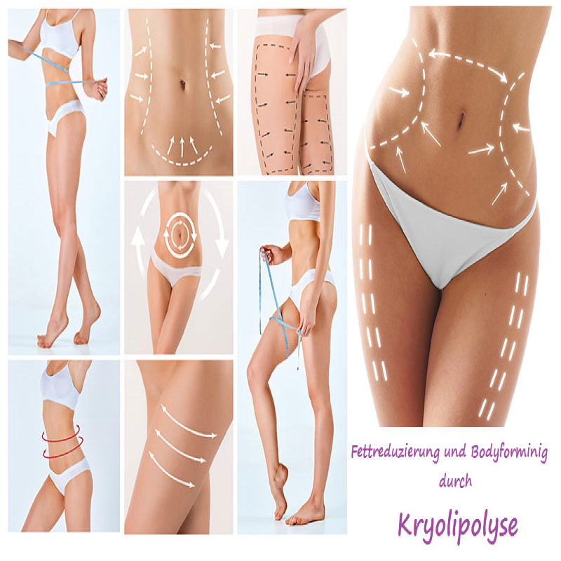 Kryolipolyse
